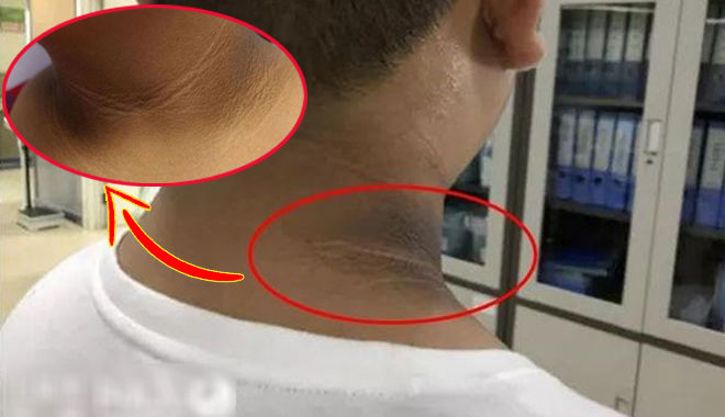 Cậu bé có "vạch màu đen" trên cổ, tưởng da bẩn hóa ra bệnh gai đen