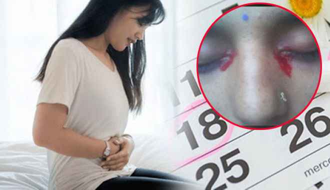 Kỳ lạ cô gái 25 tuổi cứ "đến tháng" là khóc ra máu 