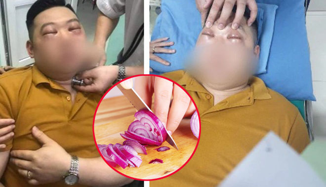 Từ vụ nam thanh niên sốc phản vệ do thái hành, lưu ý dấu hiệu mẩn ngứa