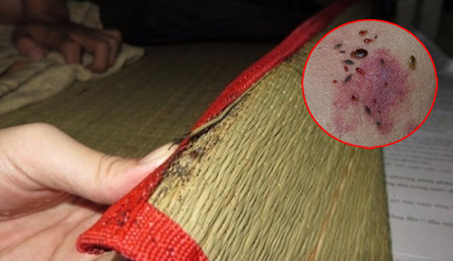 Người phụ nữ suýt nhiễm trùng máu vì rệp giường cắn: Lưu ý da mẩn đỏ