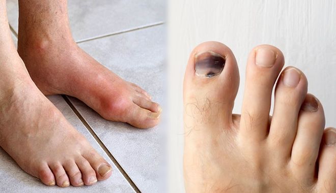 4 biểu hiện ở bàn chân cho thấy tế bào nan y đã nhắm tới bạn