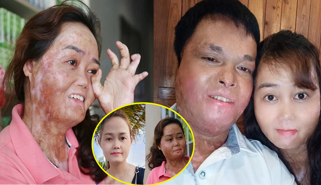 Vượt qua nỗi đau thể xác, bà mẹ hai con tìm được tình yêu đích thực