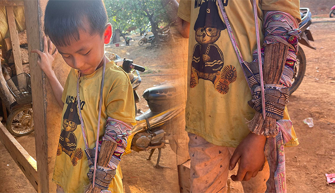 Xót cảnh cậu bé ở vùng núi phải dùng củi khô, vải vụn để nẹp cánh tay
